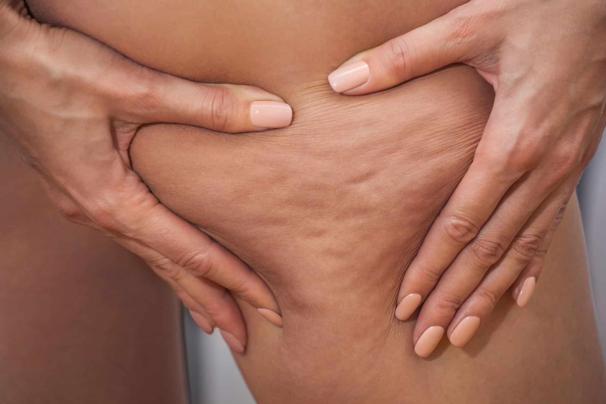 Girl shows pushing the skin of the legs cellulite.