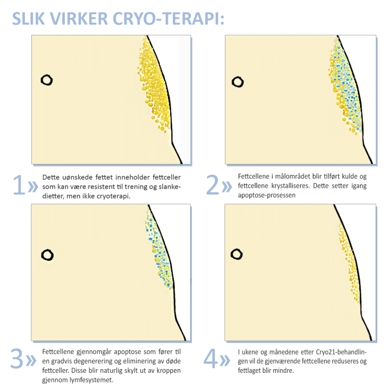 hvordan fungerer cryo behandling